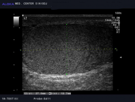 Ultrazvok testisov - normalen izvid levega testisa
